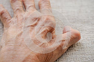 fossa between index finger and thumb on an old man hand from muscles atrophy