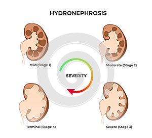 Four stages of kidney hydronephrosis. Vector illustration of the mild  moderate  severe  and terminal kidney disease