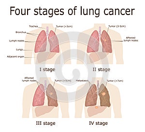 Four stages of lung cancer