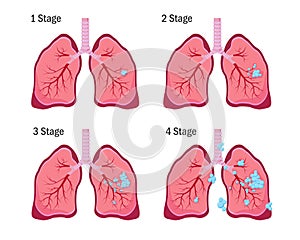 Four stages of lung cancer disease.