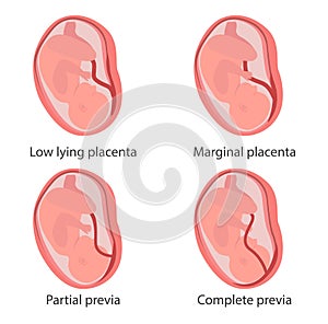 Four types of placenta previa concept illustration