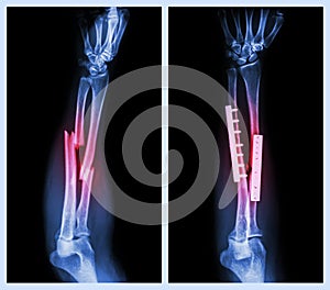 Fracture both bone of forearm. It was operated and internal fixed with plate and photo