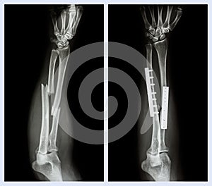 Fracture both bone of forearm. It was operated and internal fixed with plate and photo