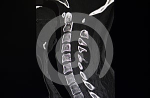 fracture C2 cervical vertebrae.