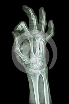 Fracture distal pharange of middle finger