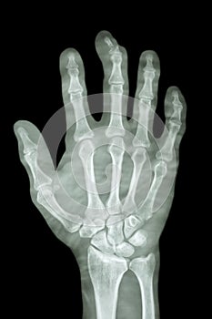 Fracture distal pharange of middle finger