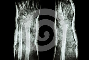 Fracture distal radius and cast