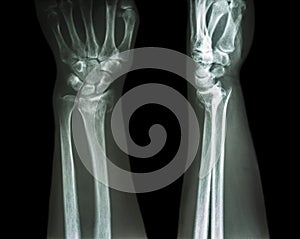 Fracture distal radius (Colles' fracture)