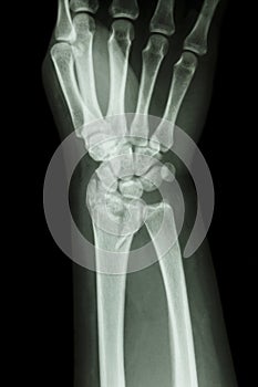 Fracture distal radius (forearm's bone)