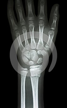 Fracture distal radius (forearm's bone) photo