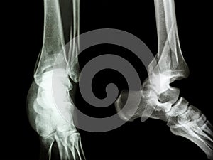 Fracture distal tibia and fibula (leg's bone)