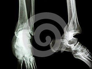 Fracture distal tibia and fibula (leg's bone) photo
