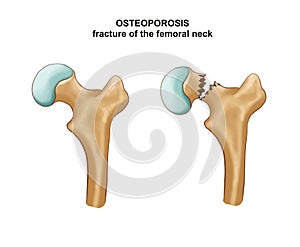 Fracture of the femoral neck. Osteosynthesis