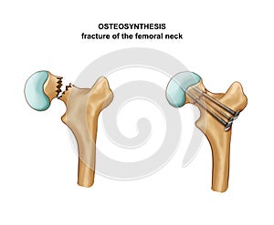 Fracture of the femoral neck. Osteosynthesis photo