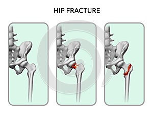 Fracture of the femoral neck. Vector photo