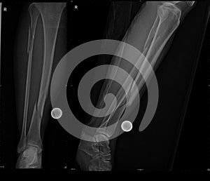 Fracture of fibular and tibial bone photo