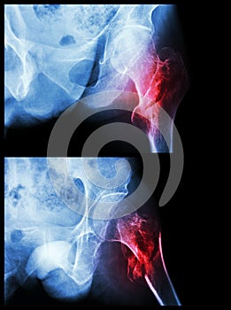 Fracture head of femur(Thigh bone) (intertrochanteric fracture) (2 position)