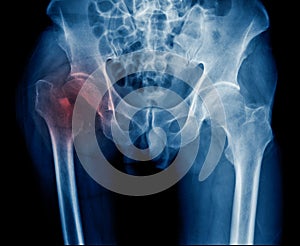 Fracture intertrochanteric of hip