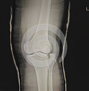 Fracture knee joint.