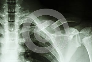 Fracture left clavicle