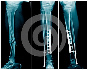 Fracture leg both bone with post operation fixation