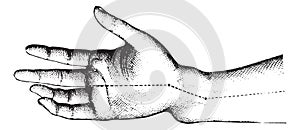 Fracture of the lower extremity of the radius. The figure shows