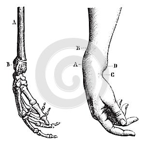 Fracture of the lower extremity of the radius, vintage engraving