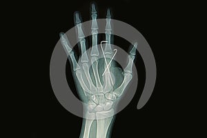 Fracture metacarpal bone insert with k-wire