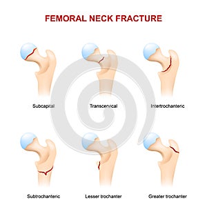 Fracture neck of femur