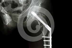 Fracture neck of femur(thigh's bone). patient was operated and f