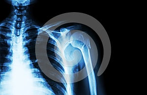 Fracture at neck of humerus ( arm bone ) ( film x-ray left shoulder and blank area at right side )