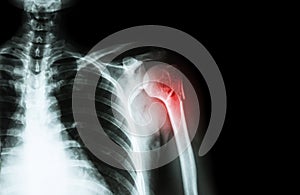 Fracture at neck of humerus ( arm bone ) ( film x-ray left shoulder and blank area at right side )