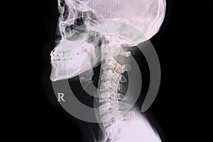 Fracture pedicle of cervical vertebra