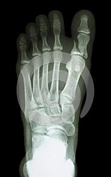 Fracture proximal phalange at first toe photo