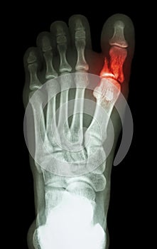 Fracture proximal phalange at first toe photo