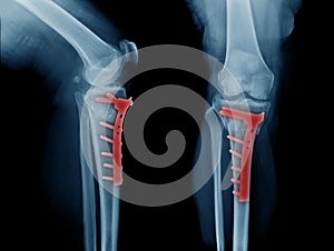 Fracture proximal tibia with internal fixation AP and lateral view