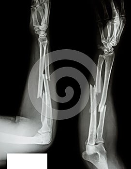 Fracture radius & ulnar bone