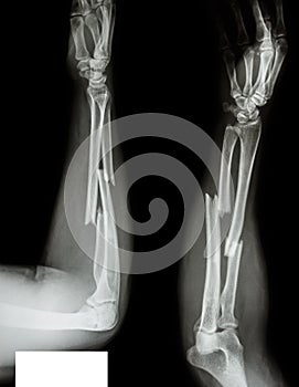 Fracture radius & ulnar bone photo