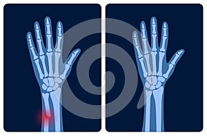 Fracture x ray concept