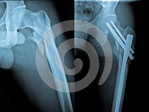 Fracture and repair of femoral bone photo