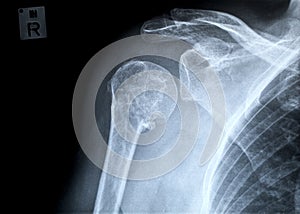 Fracture of a right human upper arm after accident photo