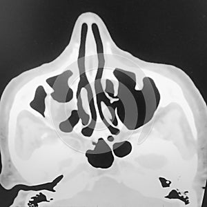 Fracture right orbital floor ct scan photo