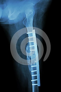 Fracture shaft of femur. It was operated and internal fixation