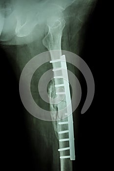 Fracture shaft of femur. It was operated and internal fixation photo