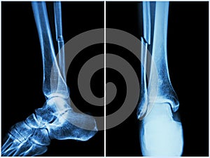 Fracture shaft of fibula bone ( leg bone ) . X-ray of leg ( 2 position : side and front view