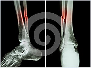 Fracture shaft of fibula bone ( leg bone ) . X-ray of leg ( 2 position : side and front view )