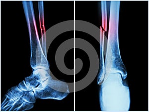 Fracture shaft of fibula bone ( leg bone ) . X-ray of leg ( 2 position : side and front view )