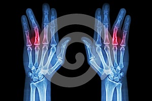 Fracture shaft of proximal phalange of ring finger ( film x-ray both hand AP )