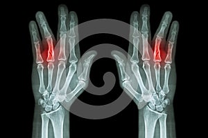 Fracture shaft of proximal phalange of ring finger ( film x-ray both hand AP ) photo