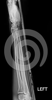 Fracture shaft of radius & ulnar bone